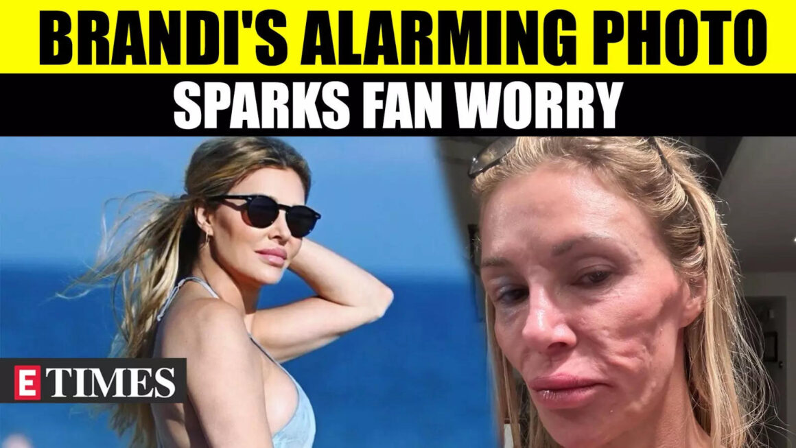 Brandi Glanville’s Unrecognizable Look With Swollen Face Sends Fans Into Panic