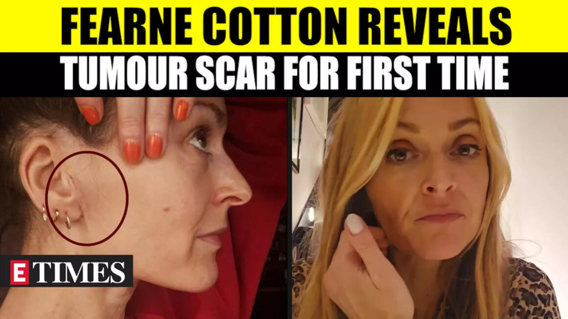 Fearne Cotton Braves Health Battle, Reveals Scar On Face For First Time Post Tumor Surgery | WATCH