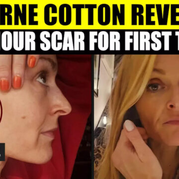 Fearne Cotton Braves Health Battle, Reveals Scar On Face For First Time Post Tumor Surgery | WATCH